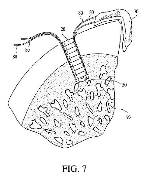 Figure on page 81 of the opinion